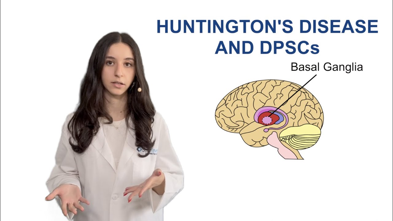 Huntington's Disease and DPSCs