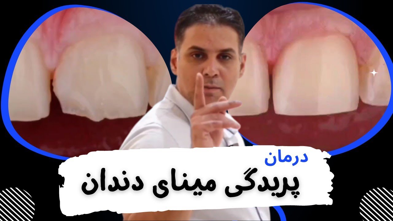 درمان پریدگی لبه دندان با استفاده از ونیر کامپوزیت |  وقتی که 
