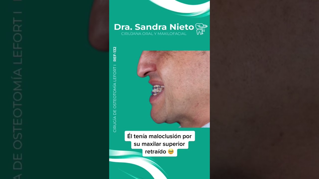 Cirug&iacute;a Lefort 1 😎#drasandranieto #pacientes #antesydespu&eacute;s #maxilofacial #greenscreen
