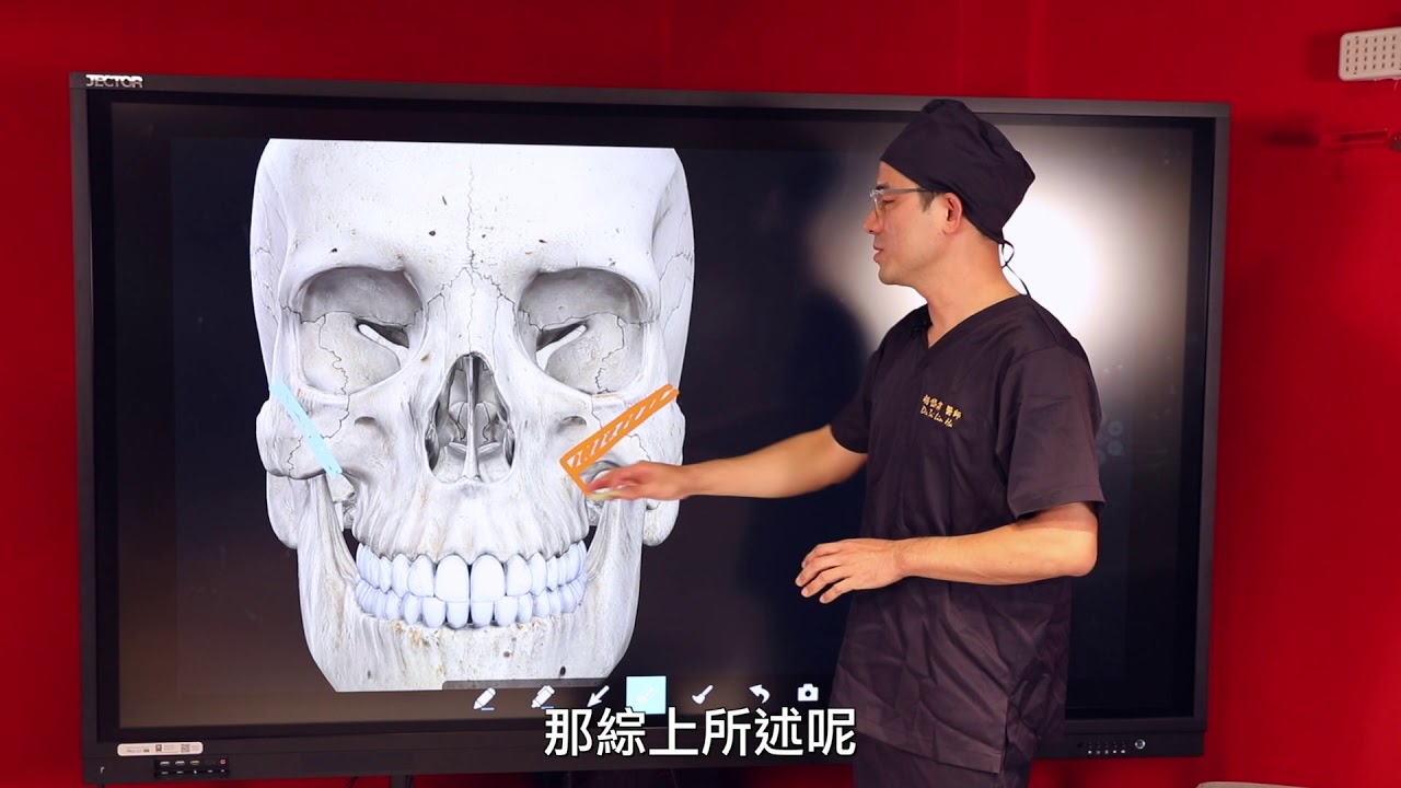 顴骨內推要用哪種方式會成功、比較不會失敗？胡岱霖醫師經驗分享