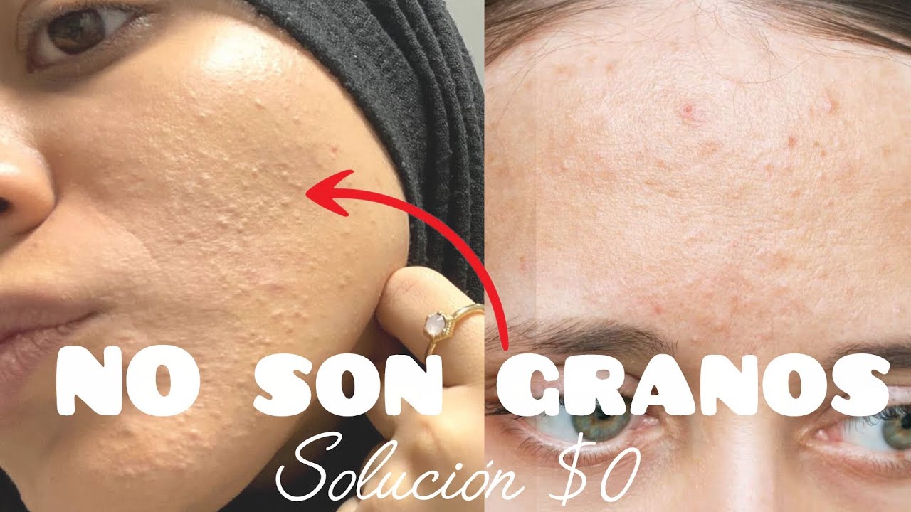 Por qué tus granitos nunca se van? Solución GRATIS y explicacion. 