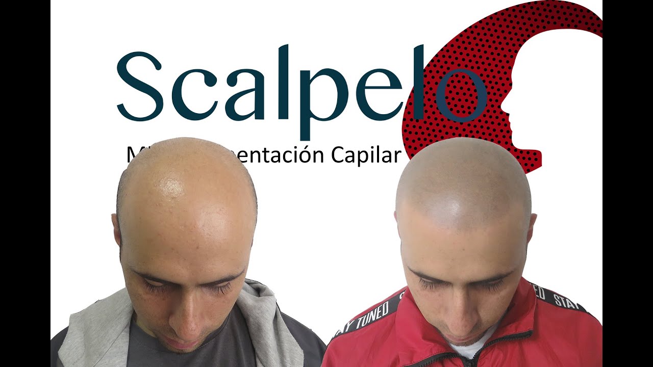 Micropigmentación capilar antes y después de Andres