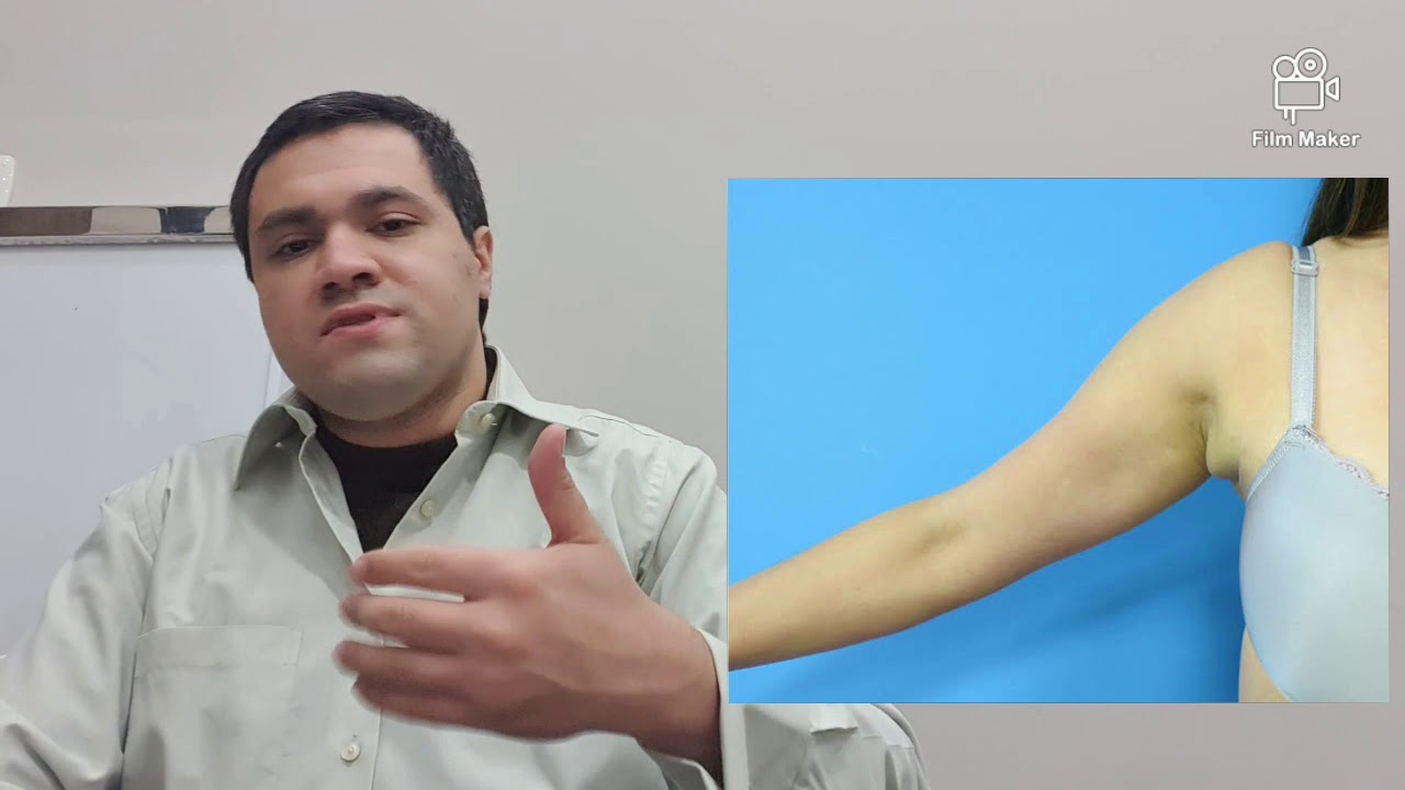 الثدي الزائد Accessory Breast