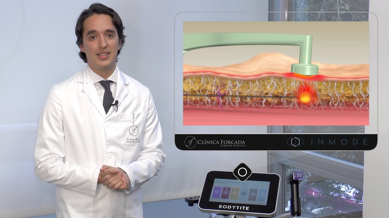 Liposucción BodyTite