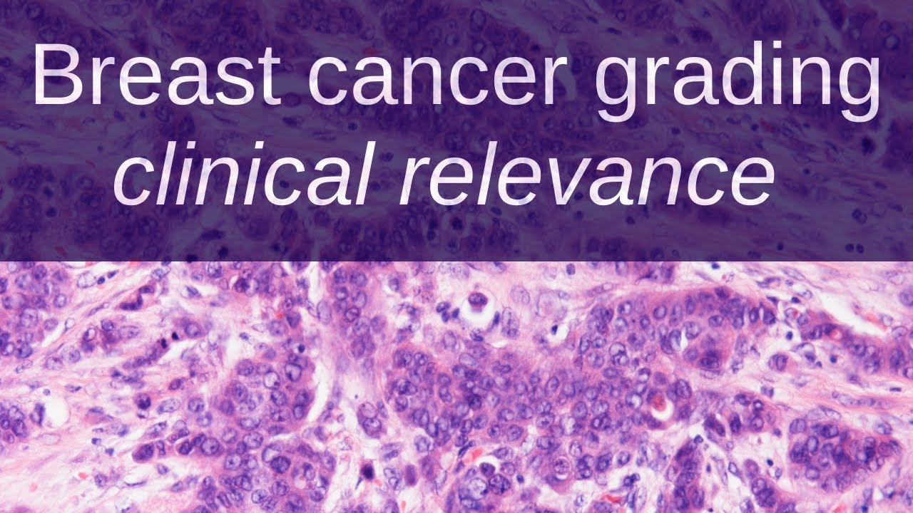 How to Grade Breast Cancer - Clinical relevance