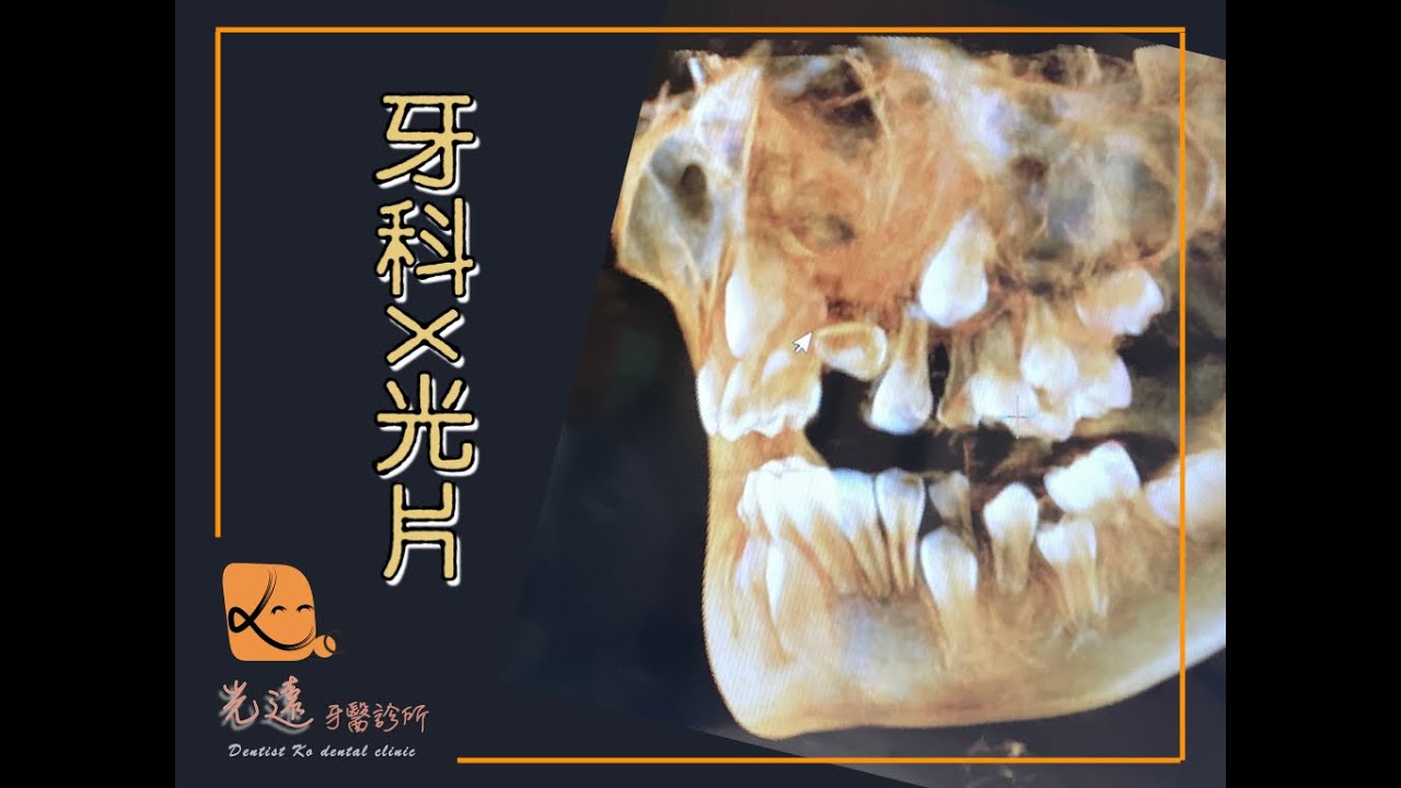 📌 牙科Ｘ光片 光遠牙醫診所 柯秀伶醫師