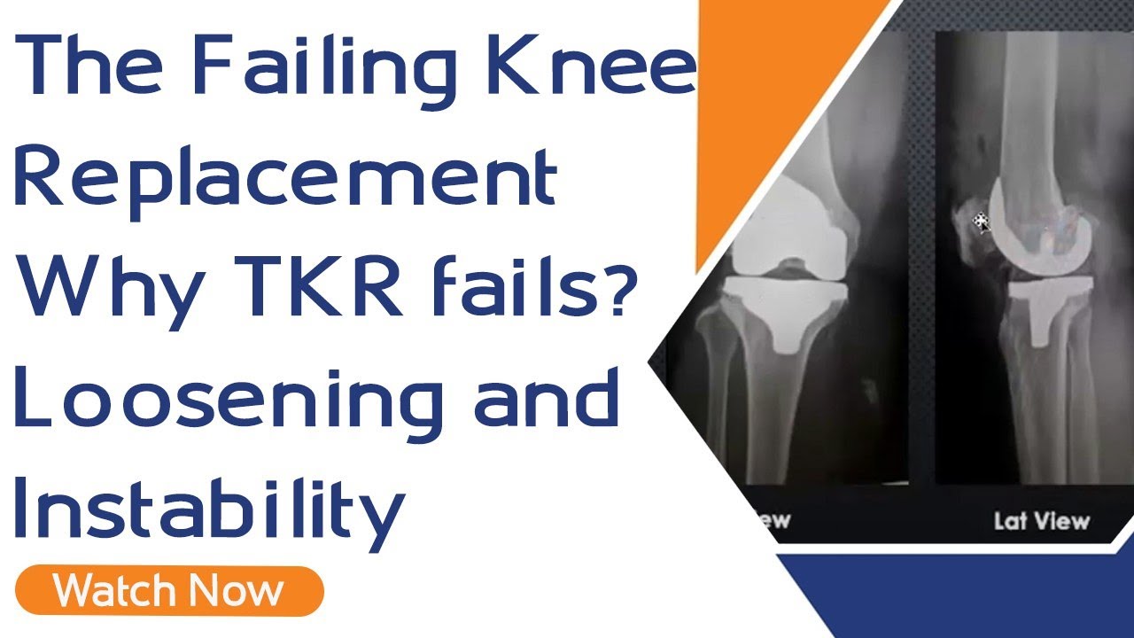 The Failing Knee Replacement - Why TKR fails?  Loosening and Instability