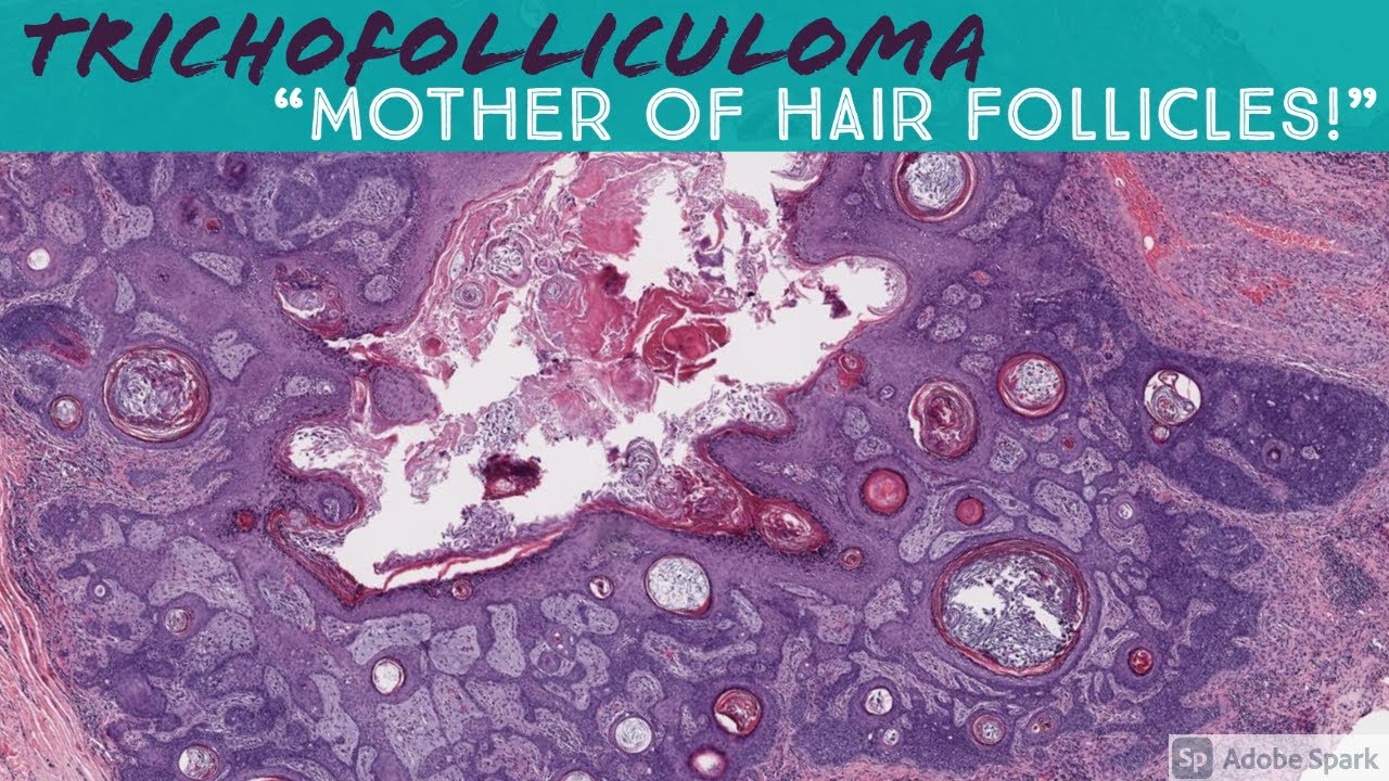 Trichofolliculoma: 5-Minute Pathology Pearls