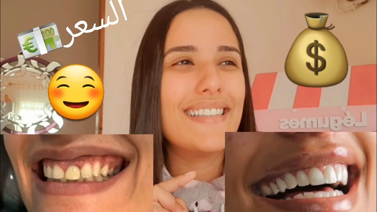 و اخيرا فيديو هوليود سمايل ❤كم سعرها 💰 الضمان 😏 هل فيه ألم 🥺 و كم يبقى عمرها 😉 هل  في متناول الجميع