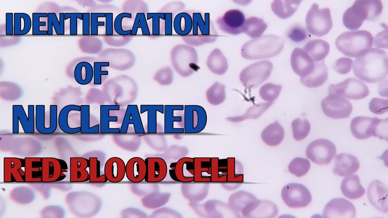 Identification Of Nucleated RBC.Cause of NRBC In PBS slide|| NRBC In blood slide|