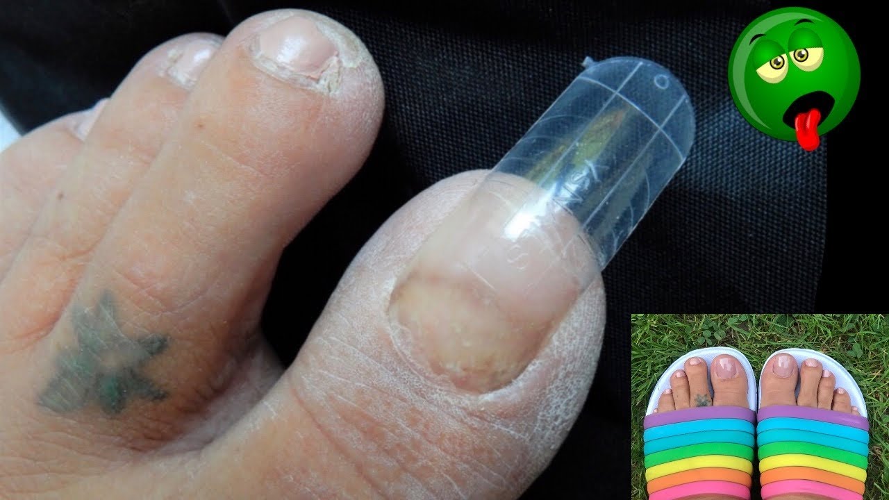 CRUSTY TOES  Made Pretty Again W/ Dual Forms & Polygel 🤢   ( No Toenails )