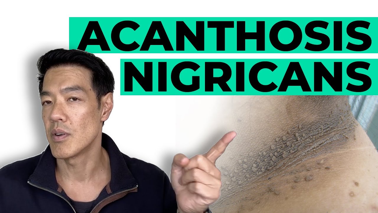 How to treat Acanthosis Nigricans | Dr Davin Lim