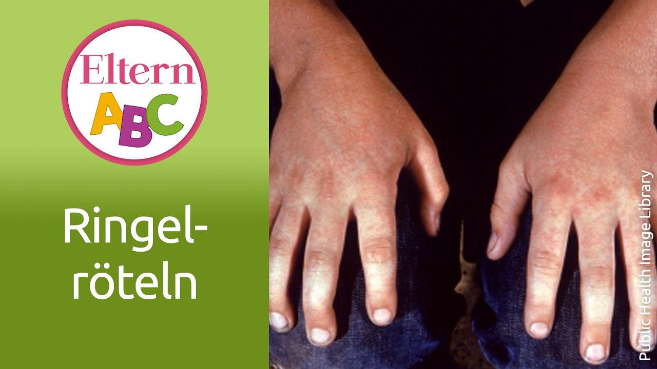 Ringelröteln | Kleinkind | Eltern ABC | ELTERN | Elternratgeber