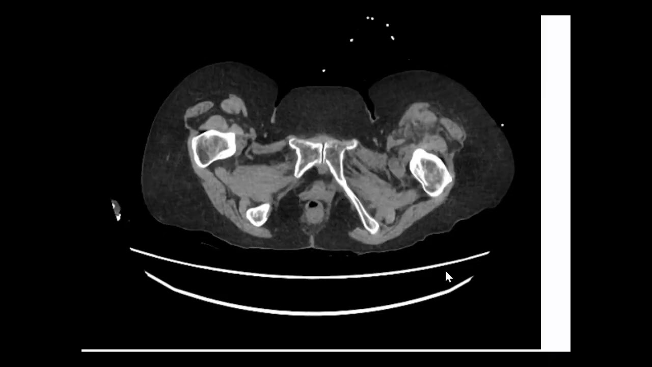 anticoagulant complication
