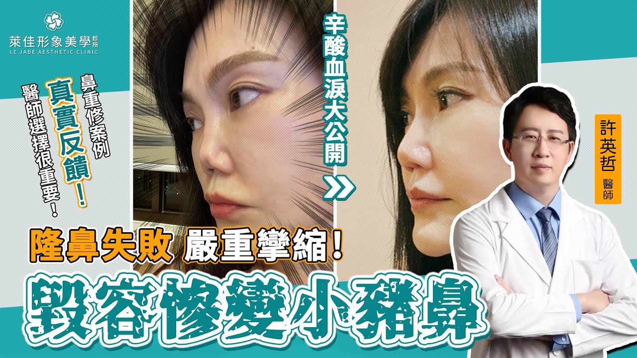 【隆鼻失敗嚴重攣縮】 鼻重修案例真實反饋！醫師選擇很重要｜萊佳 許英哲醫師