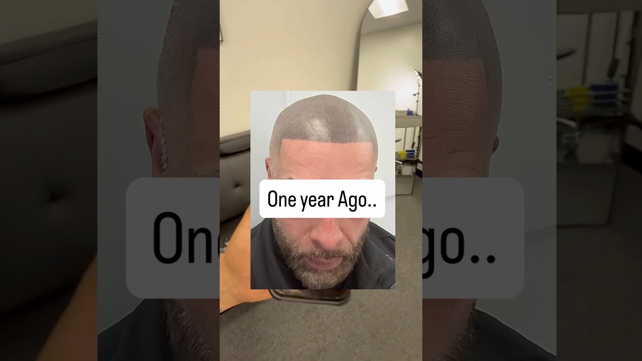Watch this before getting Scalp Micropigmentation