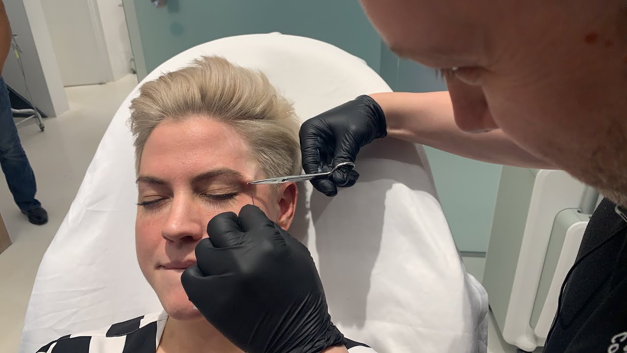 THE KENDALL JENNER #SNATCHED BROW LIFT | PDO NovaThreads | Dr. Jason Emer