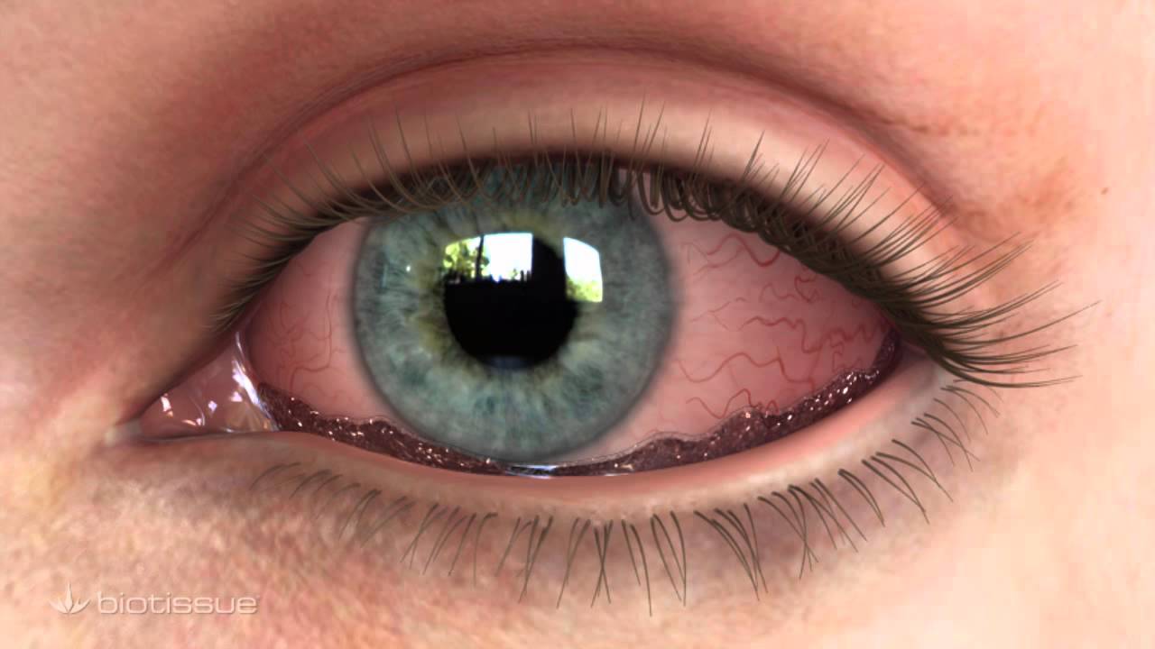 Bio-Tissue's AmnioGraft for Conjunctivochalasis (CCh)