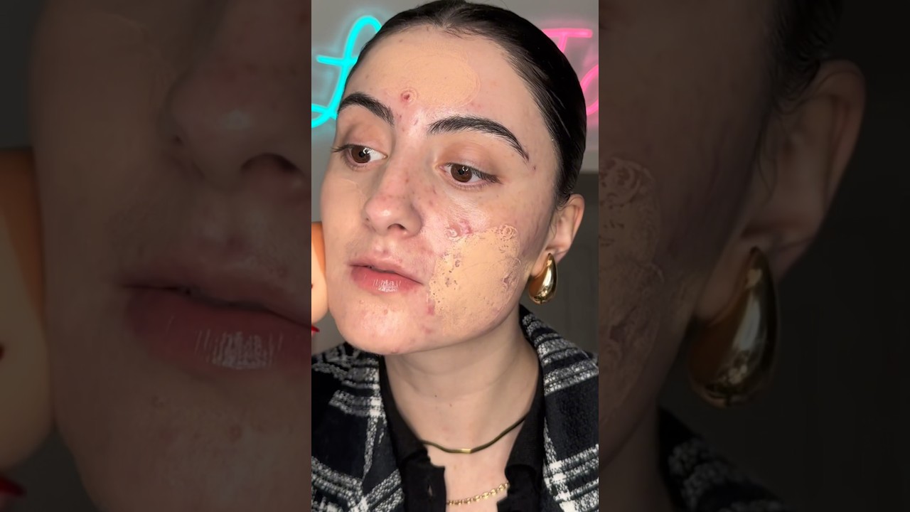 MAKEUP FOREVER HD GLOWY FOUNDATION ON ACNE/TEXTURED SKIN #acnepositivity #makeuptutorial #foundation