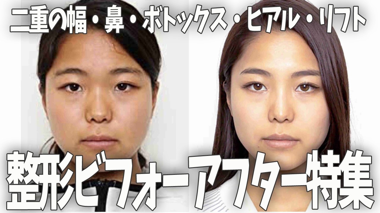 【ガルちゃん芸能】いろいろな整形芸能人のビフォーアフター【有益2ch】