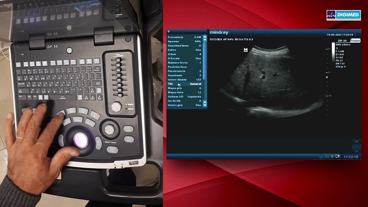 Mindray DP-30, introducción al funcionamiento del Power Doppler