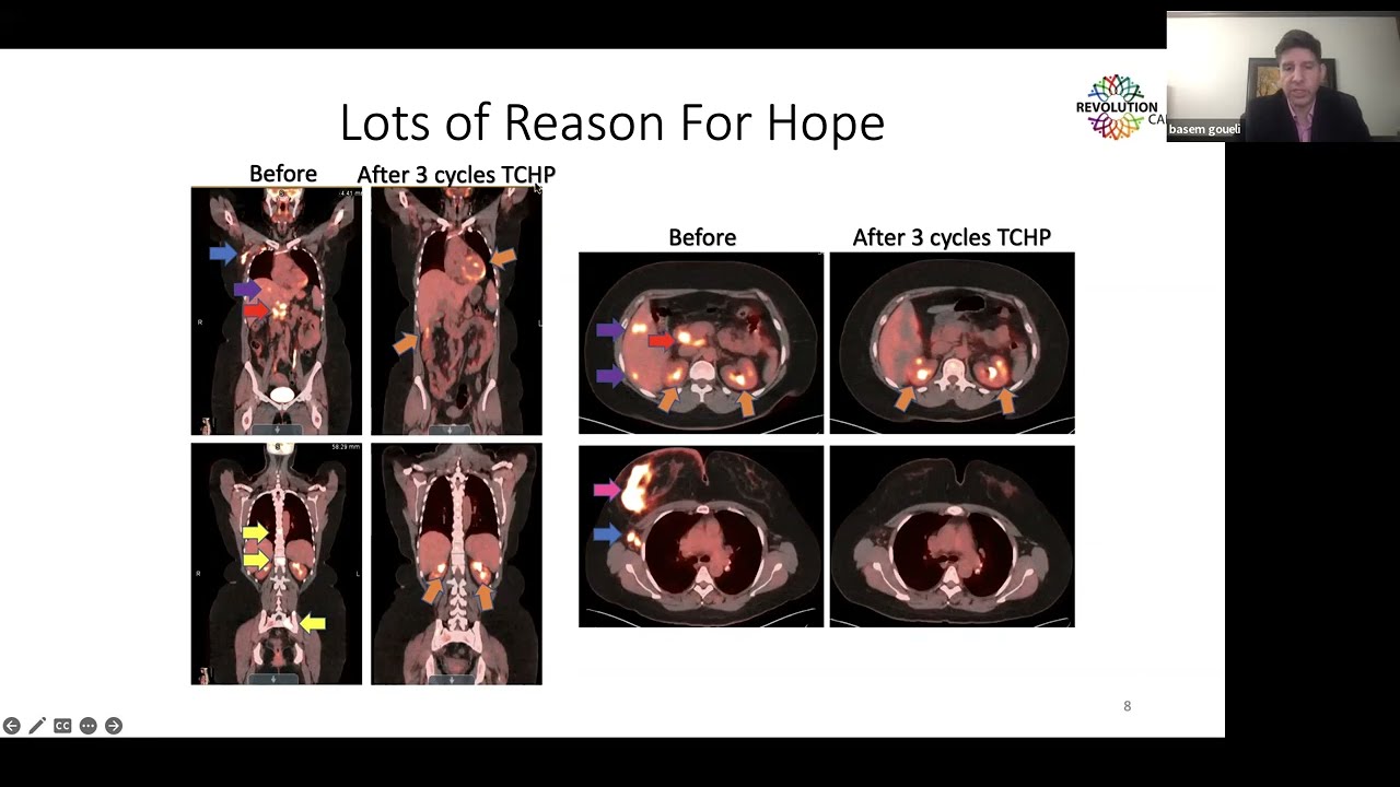 Stage 4 Breast Cancer - Part 3/4 - 