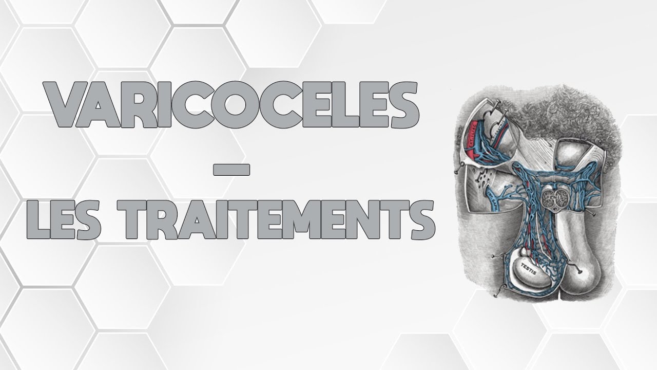VARICOC&Egrave;LE - LES TRAITEMENTS