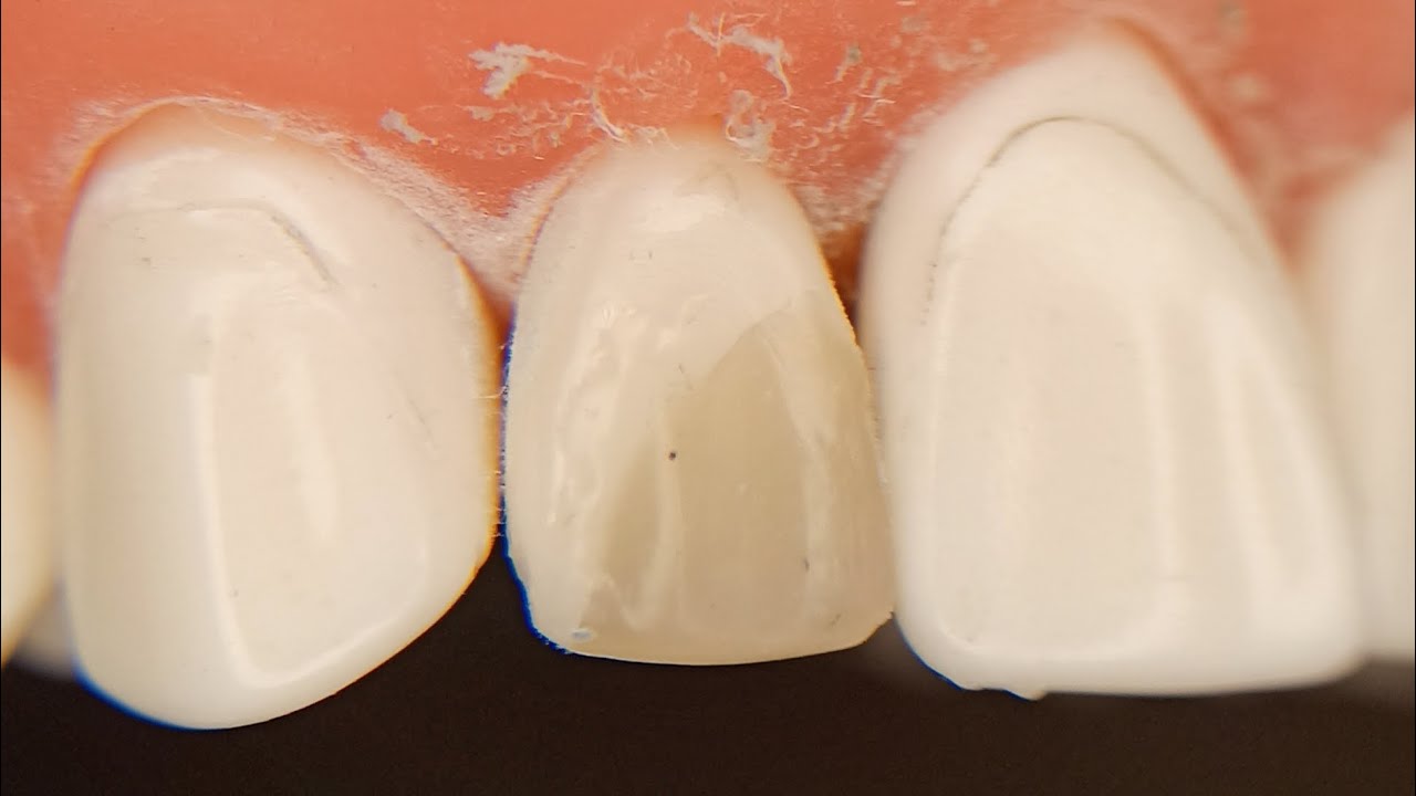 Class IV upper 2 composite filling restoration