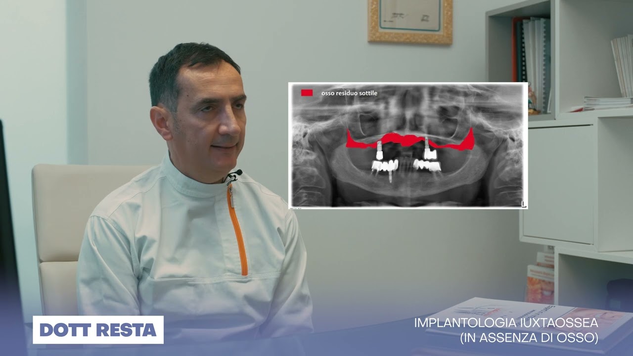 INTERVISTE AL DOTT RESTA: IMPLANTOLOGIA IUXTAOSSEA (in assenza di osso)