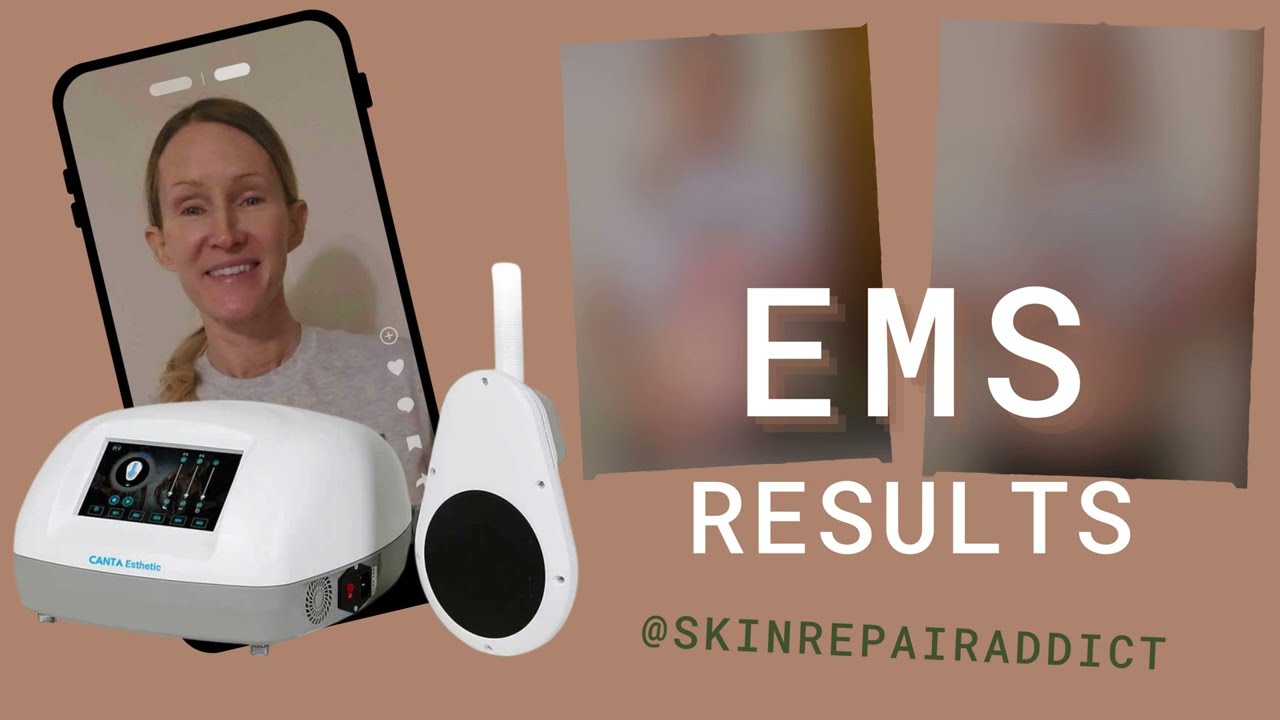 Final EMS Results - Before and After Photos!