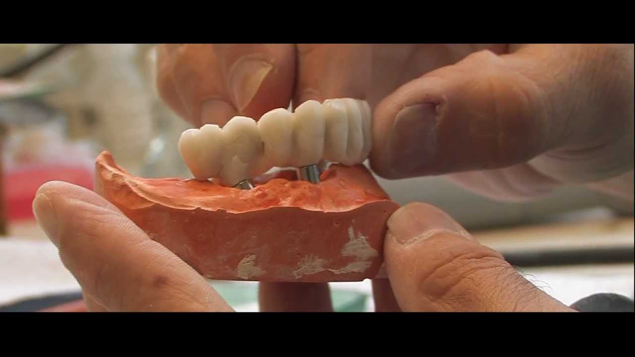 Implantációs protetika Dent-Art-Technik Kft.