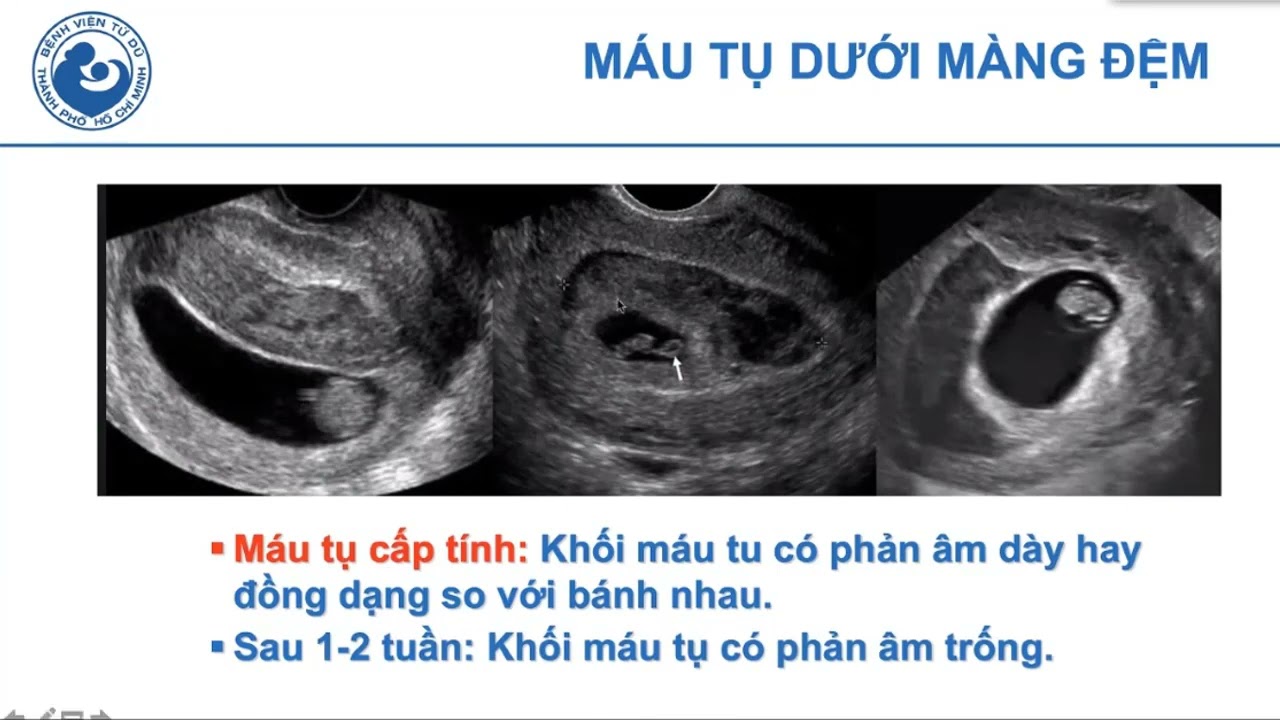 05 Siêu âm các biến chứng của thai kỳ sớm - ThS.BS. Hà Tố Nguyên