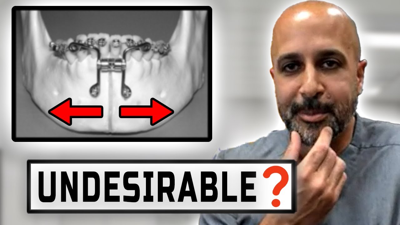 Mandibular Expansion Can be Dangerous for the TMJs