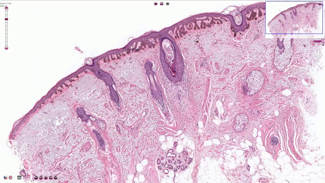 Solar Lentigo - Histopathology