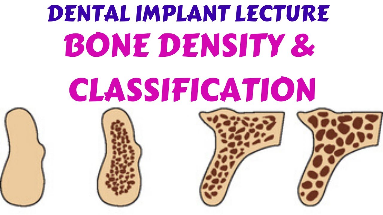 Dental Implant lecture- Bone #Density  Types of Bone, Best bone for Dental Implant