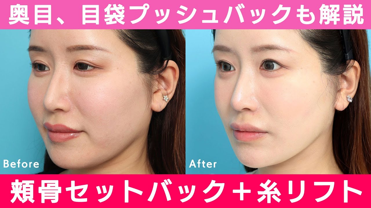 【奥目と下膨れを治療】頬骨セットバック＋糸リフト｜ヴェリテクリニック