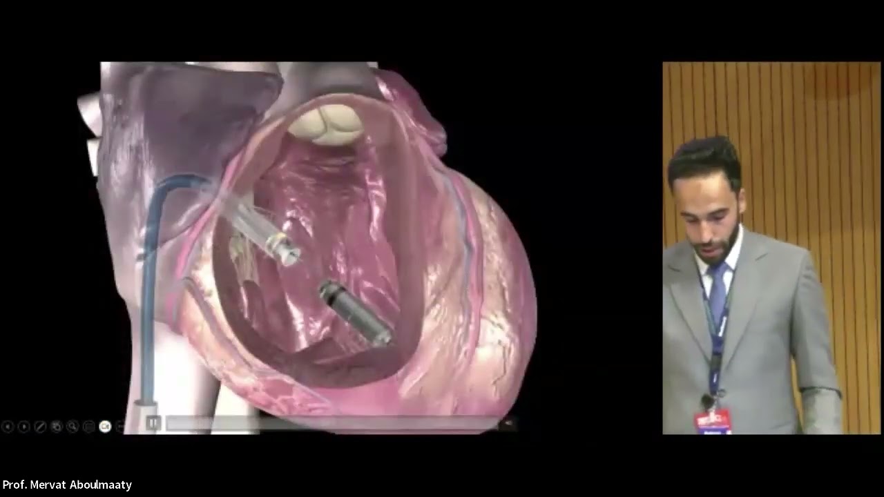HOW TO Support a Micra Leadless Pacemaker Implant - Mohamed Adel (Medtronic)