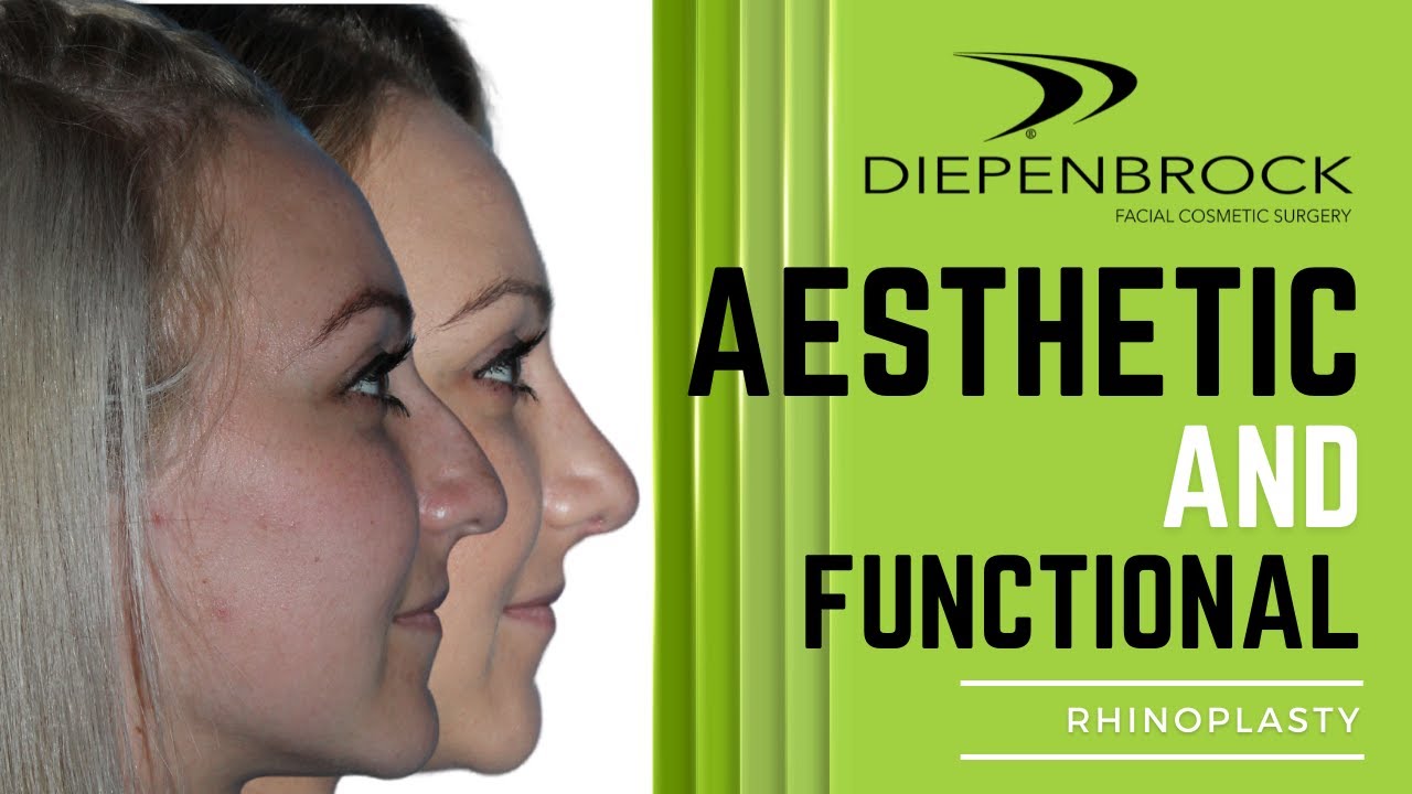 Nose Surgery - Functional and Aesthetic - Dr. D discusses Rhinoplasty Surgery!