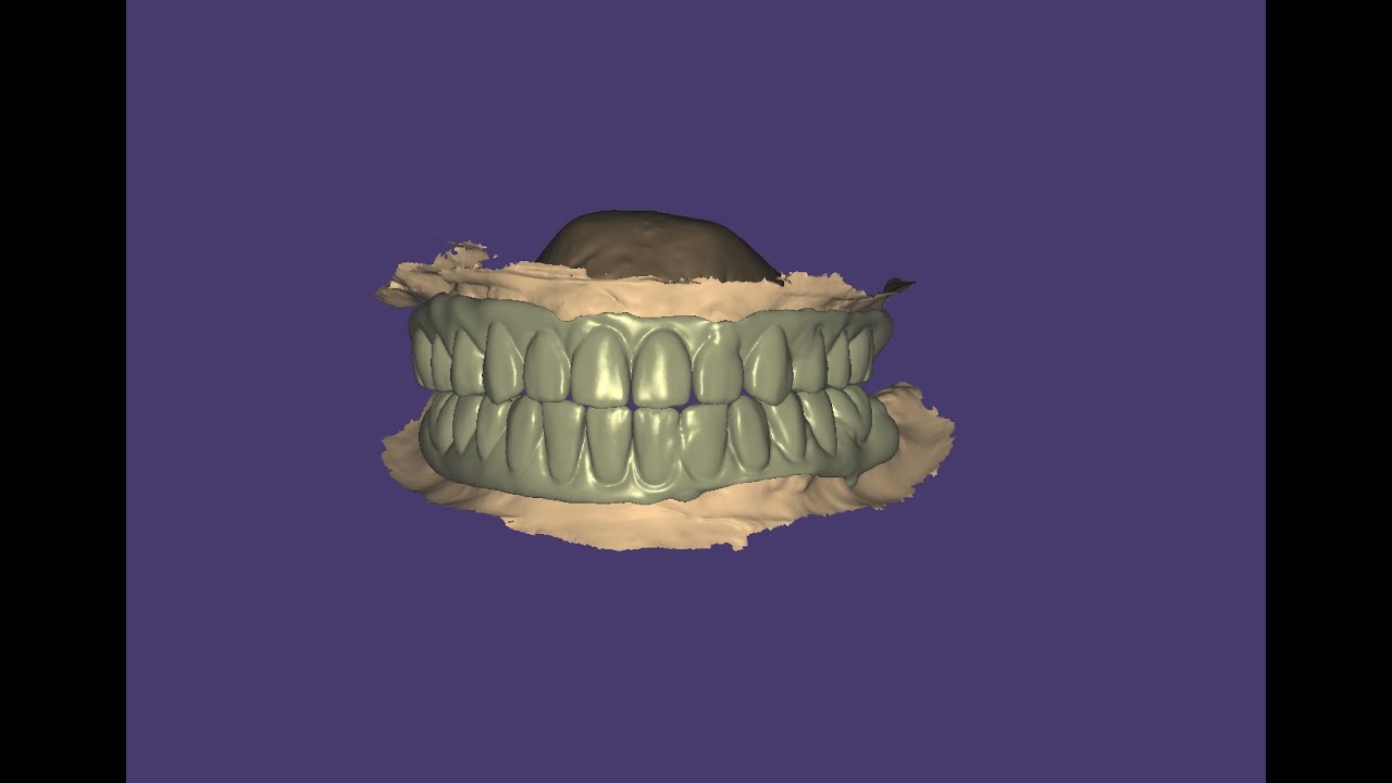How to design in exocad for full mouth pmma prosthesis?