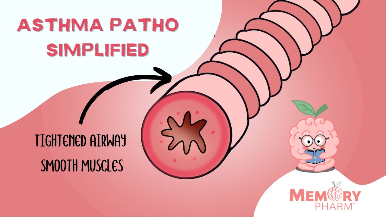 Asthma Pathophysiology Super Simplified