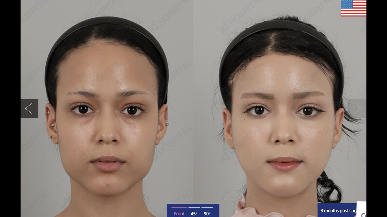 V Line & Forehead Reduction Q&A With Model | Seoul Guide Medical