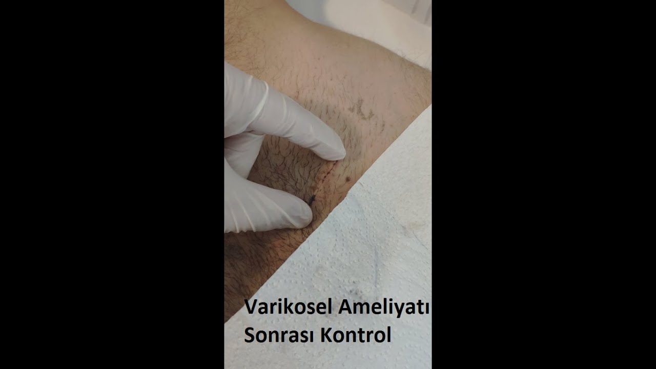 #Mikrocerrahi #Varikosel Ameliyatı Sonrası Yara Yeri 10. gün Kontrol ve Hasta Görüşü.