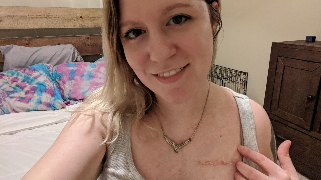 I just had my pacemaker replacement surgery