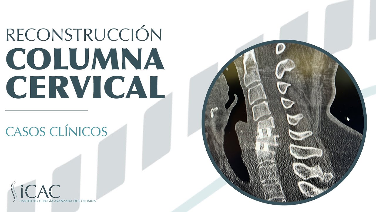 🔵 ¡Reconstrucción de COLUMNA CERVICAL! 🔵