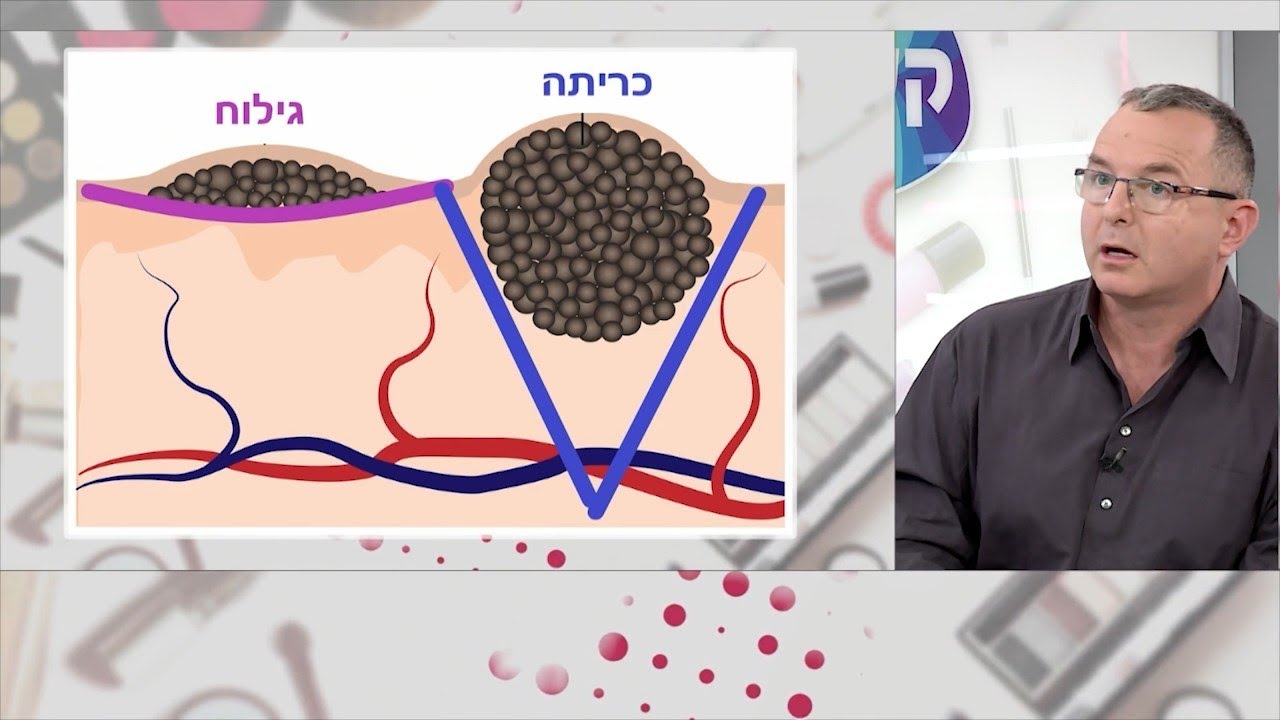 דר' יואב אברהמי מומחה הבית מרגישות יופי - נקודות חן
