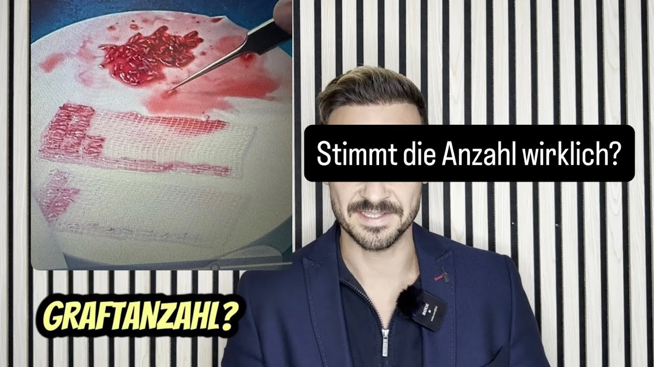 Wurden mir zu wenige Grafts eingesetzt? So überprüfst du es wirklich !