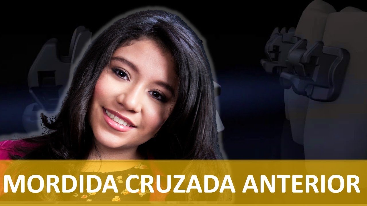 Mordida Cruzada Anterior