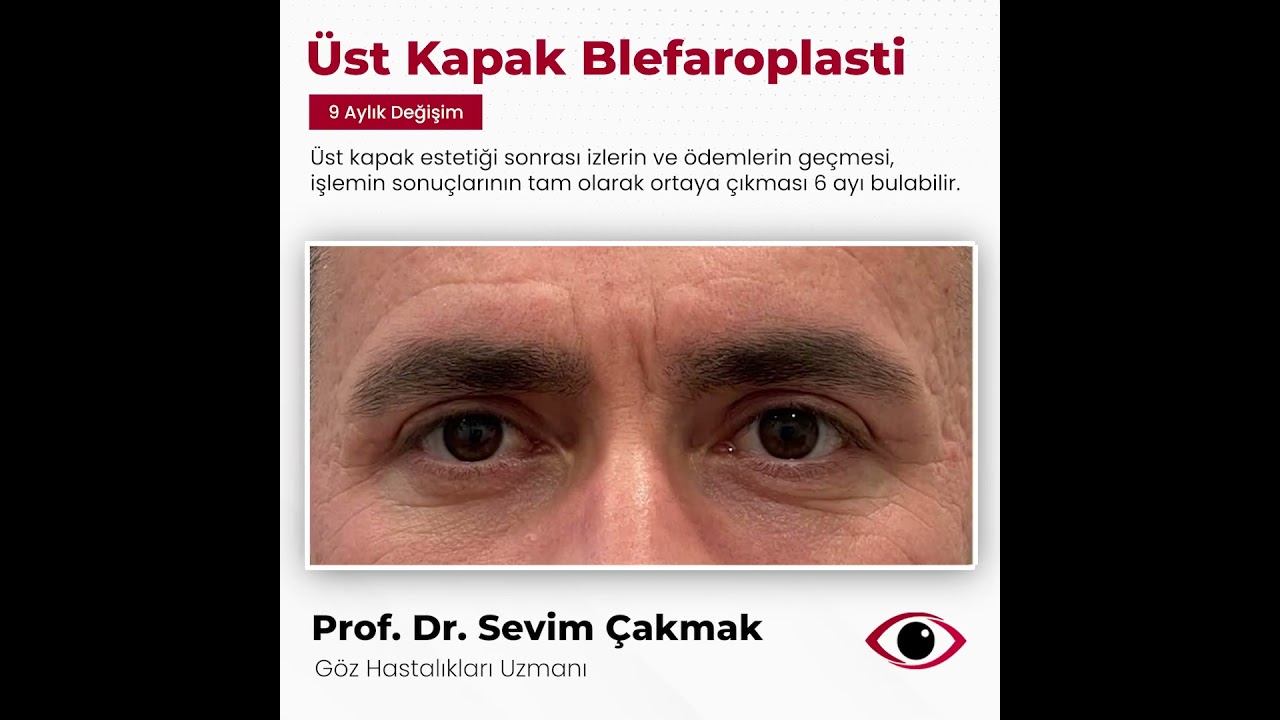 &Uuml;st Kapak Blefaroplasti | Prof. Dr. Sevim &Ccedil;akmak