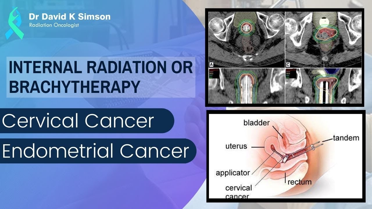Brachytherapy or Internal Radiation of Cervical & Endometrial Cancer - Dr. David K Simson