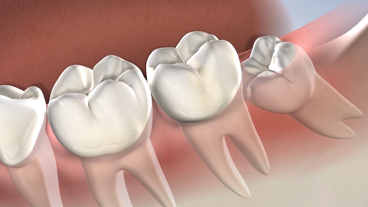 Wisdom Tooth Extraction in Waco TX | Brazos Oral & Facial Surgery